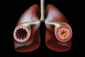 III стадия астмы